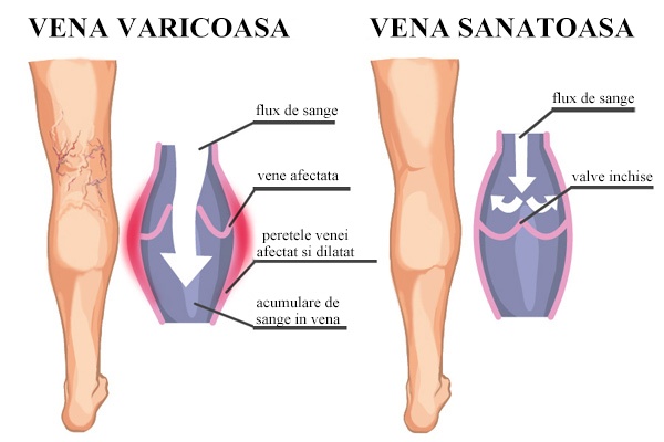 Cum se efectuează intervenția chirurgicală pentru a elimina venele piciorului