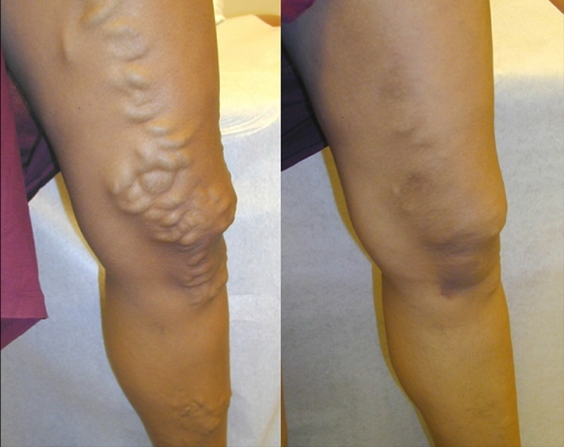 Eczema varicoasă, Eczema cu tratament pentru picioare varicoase